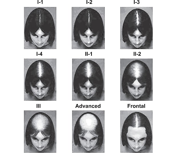 The Savin Scale of female hereditary hair loss (via the American Hair Loss Association).