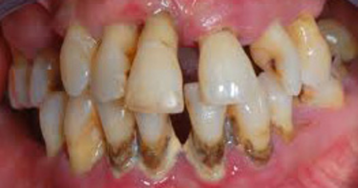 severe periodontitis